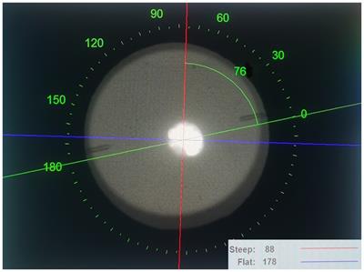 Effect of long-term rotation on astigmatism following EVO-toric intraocular collamer lens implantation